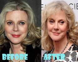 Blythe Danner before surgery